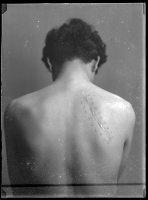 Paziente visto di dorso con cicatrice