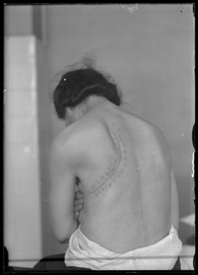 Paziente visto di dorso con cicatrice presso il Sanatorio di Alessandria