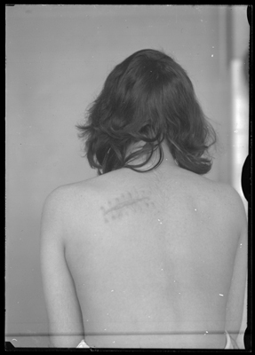 Paziente vista di dorso con cicatrice presso il Sanatorio di Alessandria